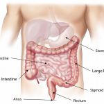 Signs and symptoms of colon cancer